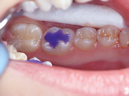 Caries dentaires Sugiez