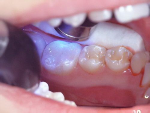 Caries dentaires Sugiez