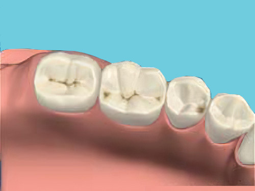 Pathologies dentaires carie dentaire