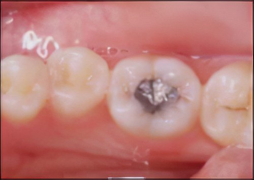 Composite dentaire 3 Sugiez