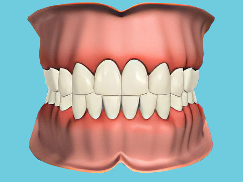 Pathologies dentaires Déchaussement dentaire Sugiez