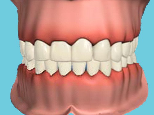 Gingivite Sugiez