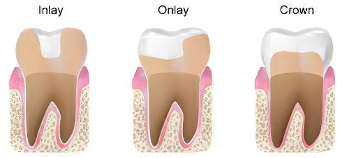 Inlay Onlay Sugiez