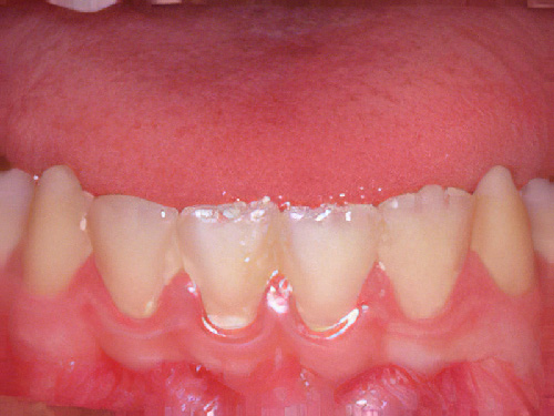 Pathologies dentaires Plaque dentaire Sugiez