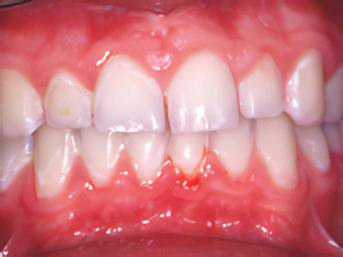 Pathologies dentaires Plaque dentaire Sugiez
