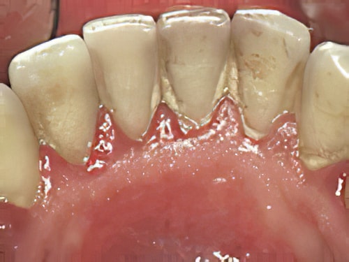 Pathologies dentaires tartre dentaire Sugiez