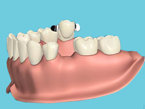 dentiste Cudrefin remplacement des dents manquantes bridge colle