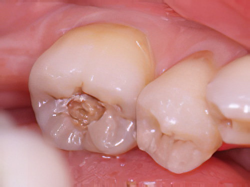 La maladie parodontale dentiste Cudrefin déchaussement dentaire