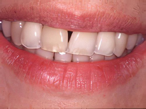 Couronne dentaire Sugiez