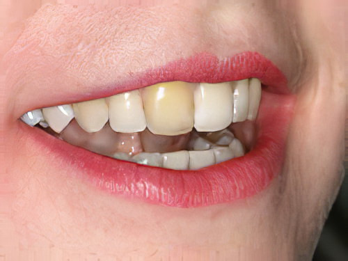 Couronne dentaire Mont Vully