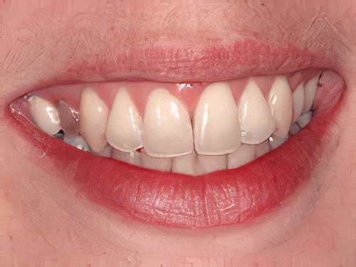 Couronne dentaire Vallamand