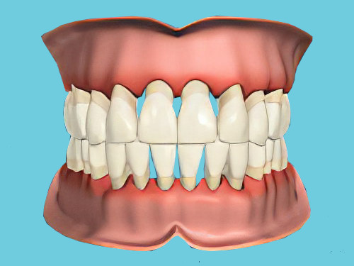 La maladie parodontale dentiste Cudrefin déchaussement dentaire