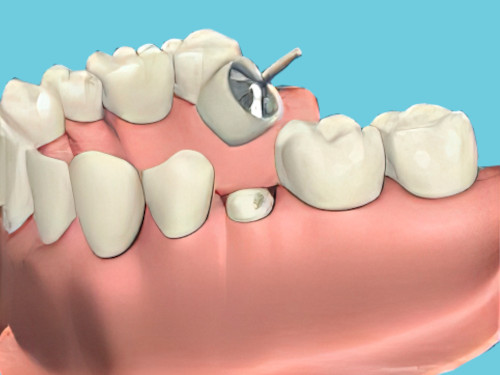 Dent sur pivot- Sugiez