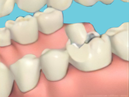 Fracture Dentaire Sugiez