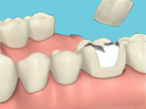 Carie dentaire Gampelen