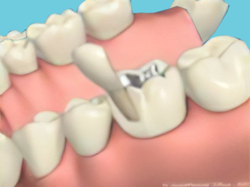 Carie dentaire Gampelen