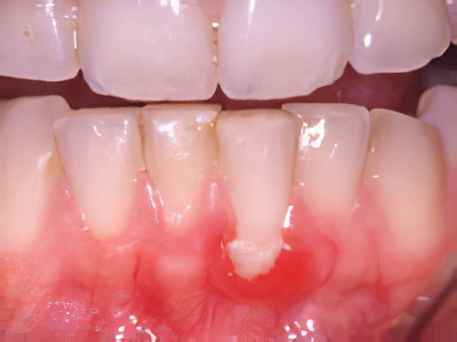 dentiste Gals gingivite