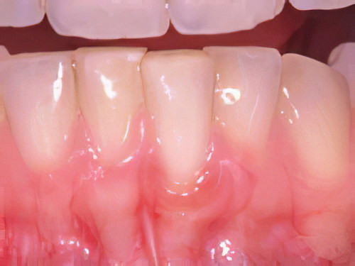 dentiste gals gingivite