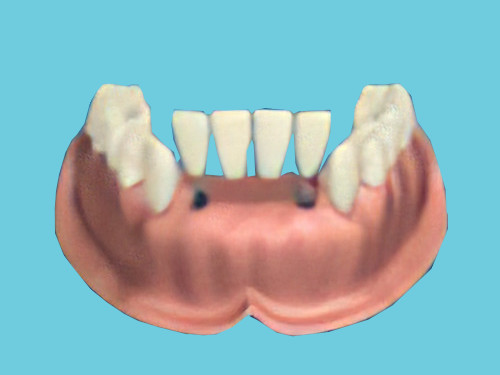 dentiste Cudrefin, remplacement des dents manquantes, implants dentaires