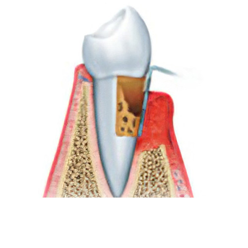 dentiste Gals maladie parodontale