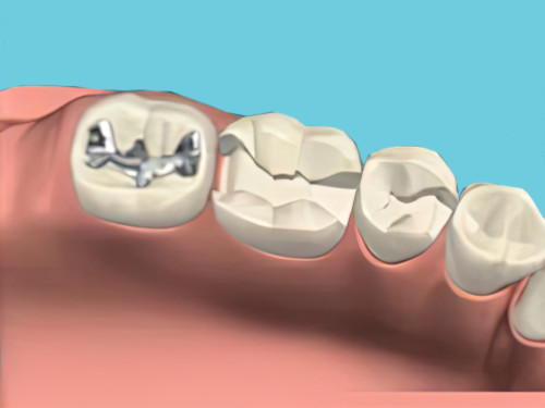 Obturation dentaire Sugiez