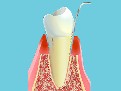 La maladie parodontale dentiste Cudrefin parodontite
