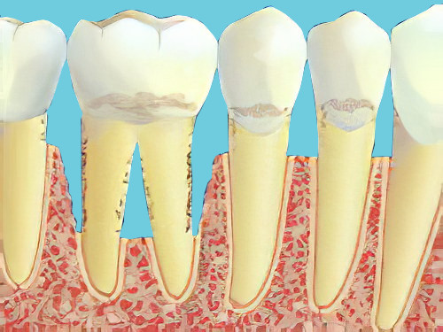 La maladie parodontale dentiste Cudrefin parodontite 03