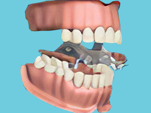 dentiste Cudrefin, remplacement des dents manquantes, prothèse amovible