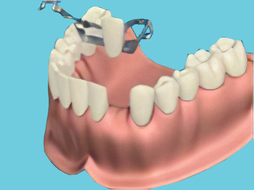 dentiste Gals prothèse amovible