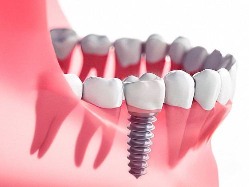 Dentiste Cudrefin implant dentaire