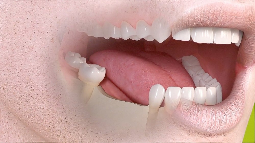 Dentiste Cudrefin Bridge sur Implants dentaires Sugiez