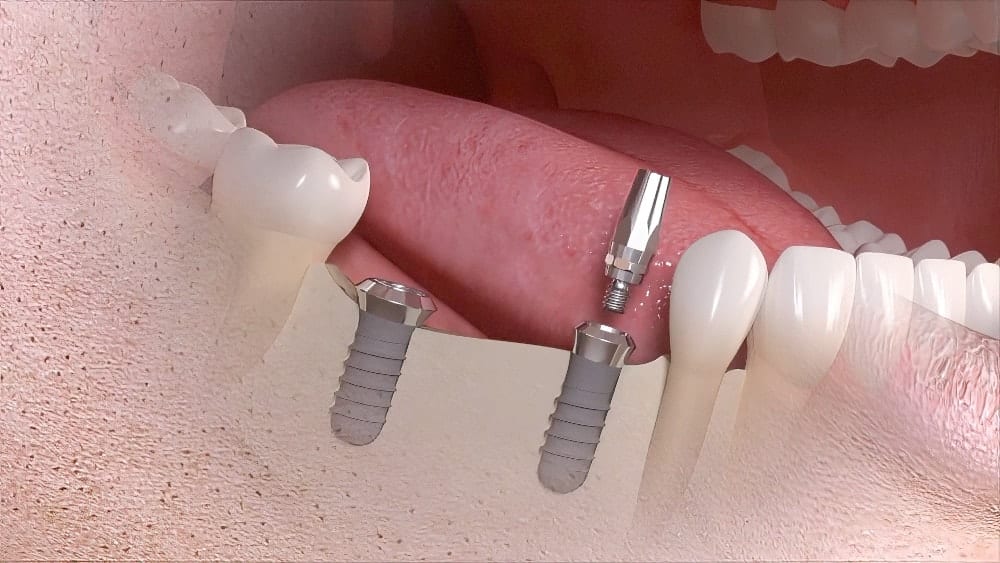 Dentiste Vallamand Bridge sur Implants dentaires Sugiez