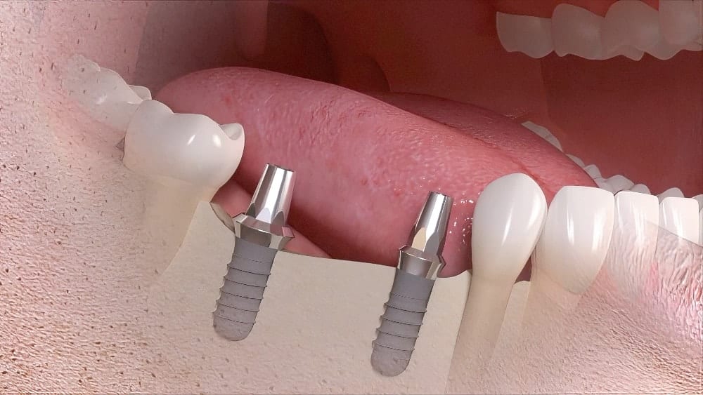 Dentiste Cudrefin Bridge sur Implants dentaires Sugiez