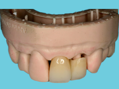 dentiste Vallamand Couronne-Dentaire-04