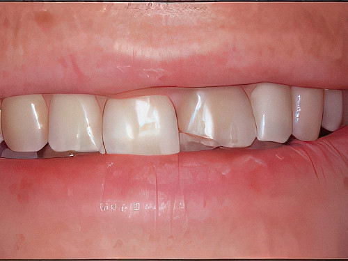 Dentiste Vallamand Dent_Devitalisee_02