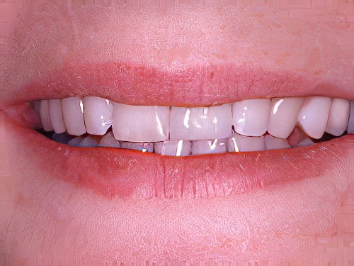 Dentiste Vallamand Dent_composite_06