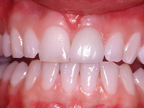 Dentiste Vallamand Dent_composite_10