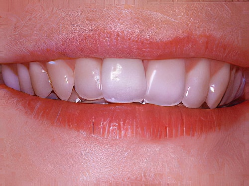 Dentiste Vallamand Dent_devitalisee_02