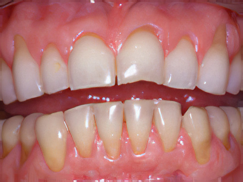 Dentiste Vallamand Eclaircissement-Dentaire-1