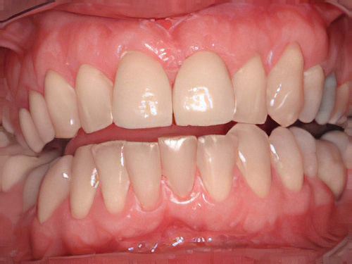 Dentiste Vallamand Facette-dentaire-2