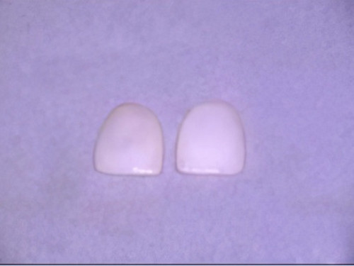 Dentiste Vallamand_Facettes_Dentaires_4