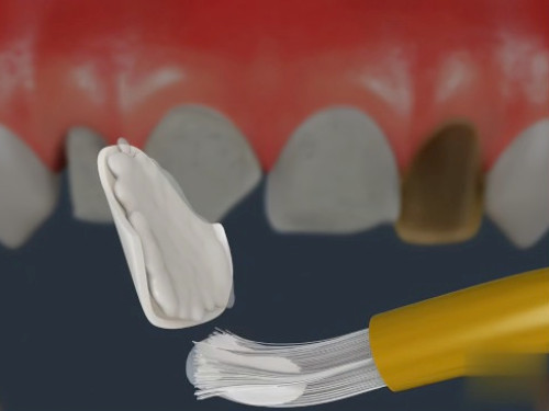 Dentiste Vallamand_Facettes_Dentaires_5