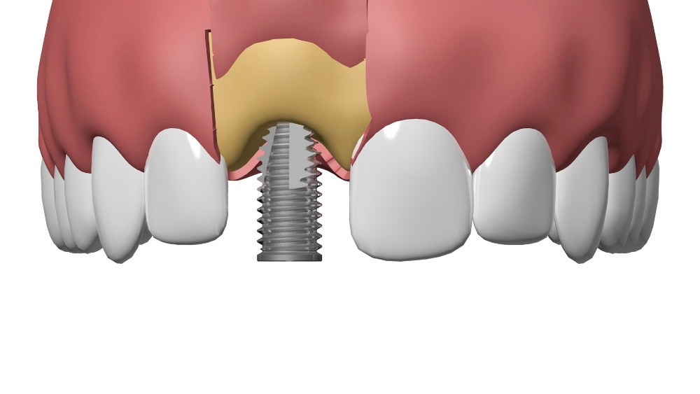 Dentiste Vallamand Implant_dentaire Sugiez