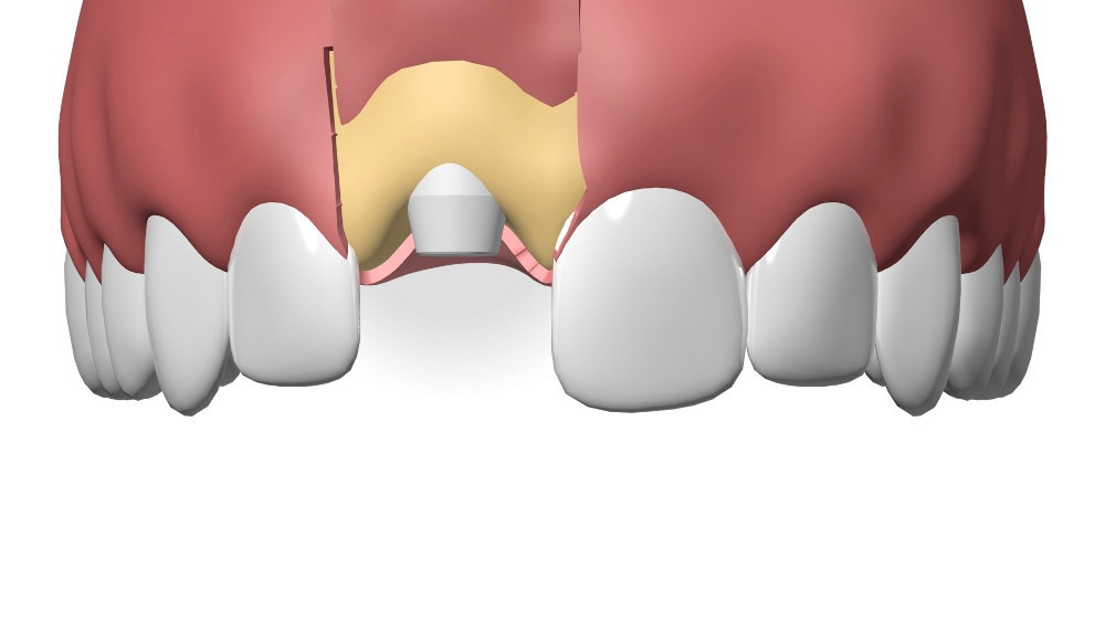 Implant Dentaire Sugiez