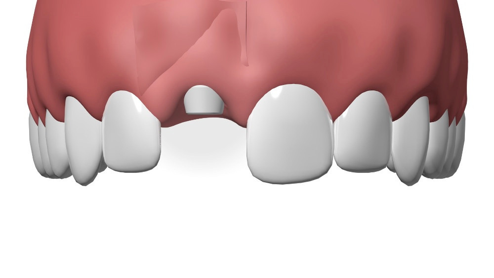 Implant Dentaire Sugiez