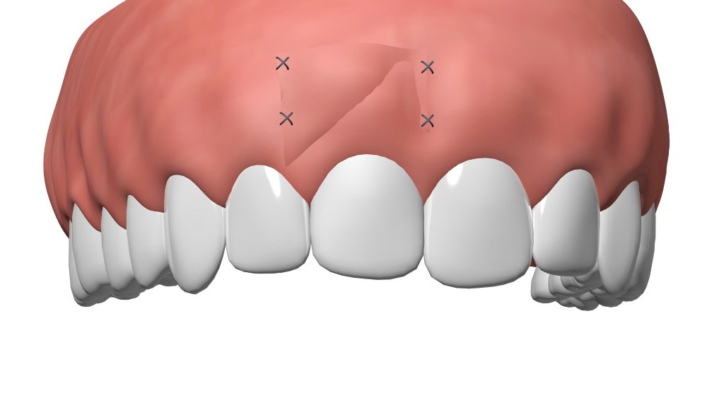 Implant Dentaire Mont de Vully