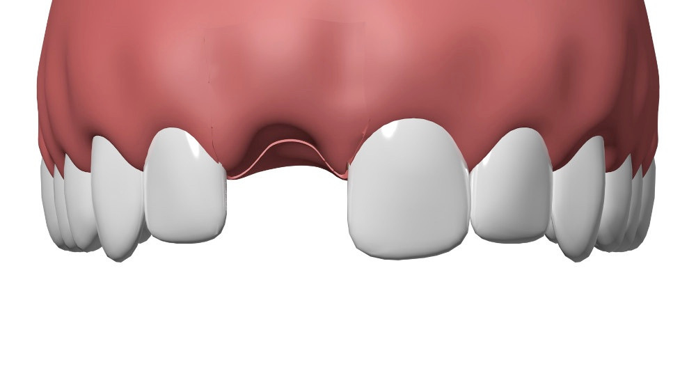 Dentiste Cudrefin Implant dentaire Sugiez