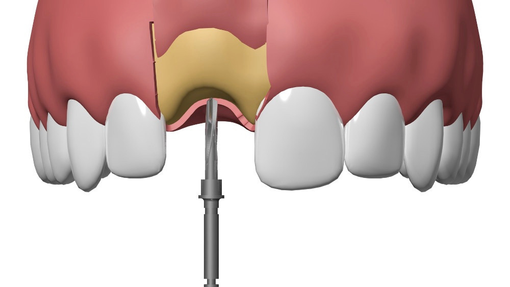 Dentiste Cudrefin Implant_dentaire Sugiez