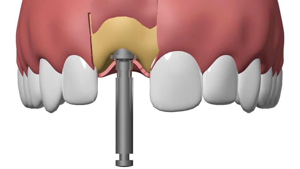Dentiste Cudrefin Implant_dentaire Sugiez