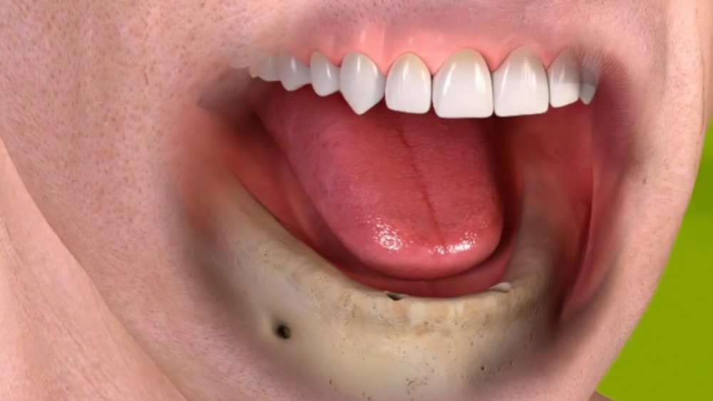 Dentiste cudrefin Implantologie dentaire